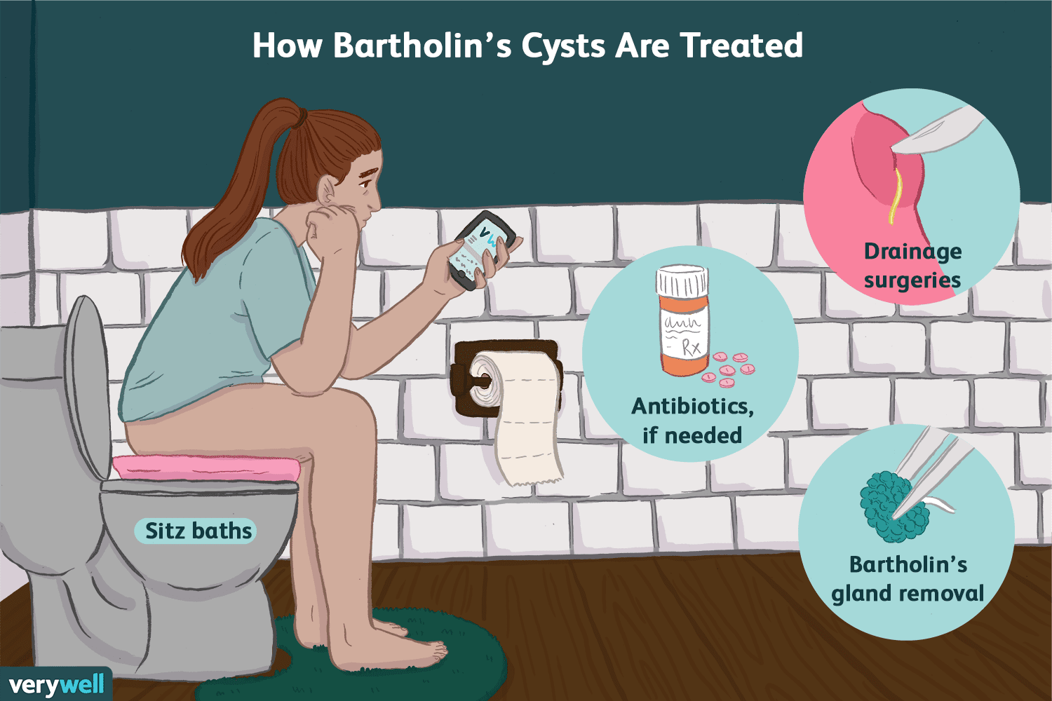 bartholins cyst