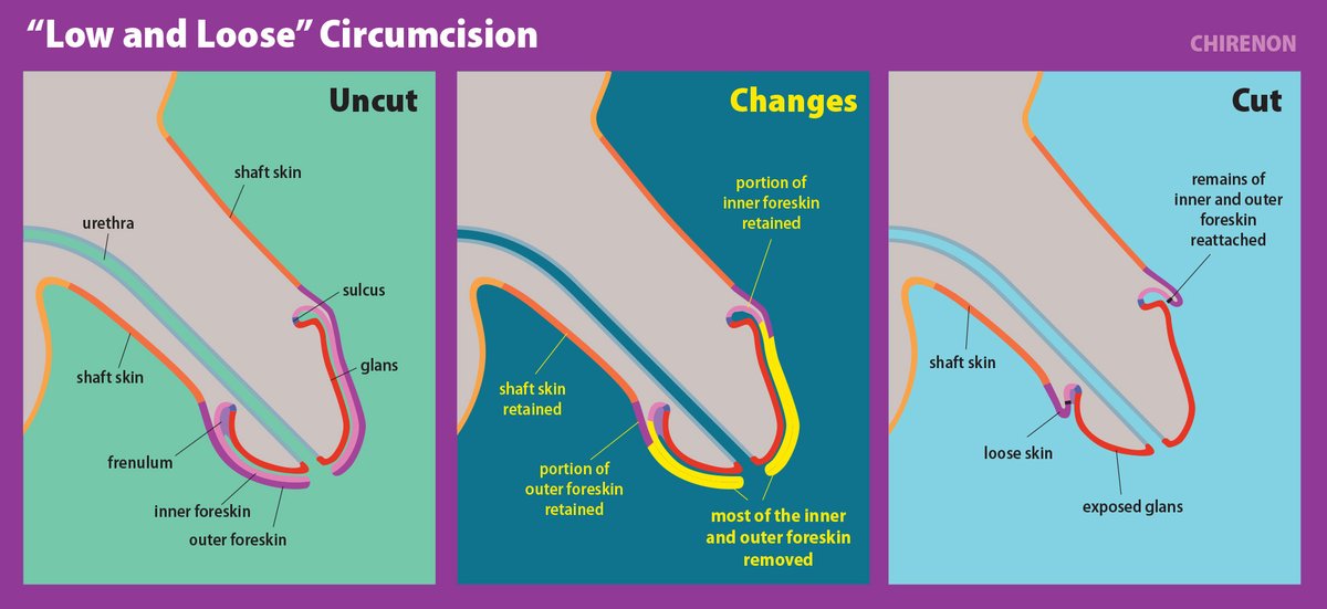 circumcision probs