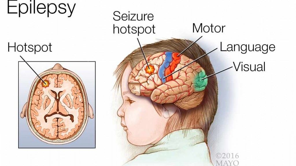 epilepsy seizures