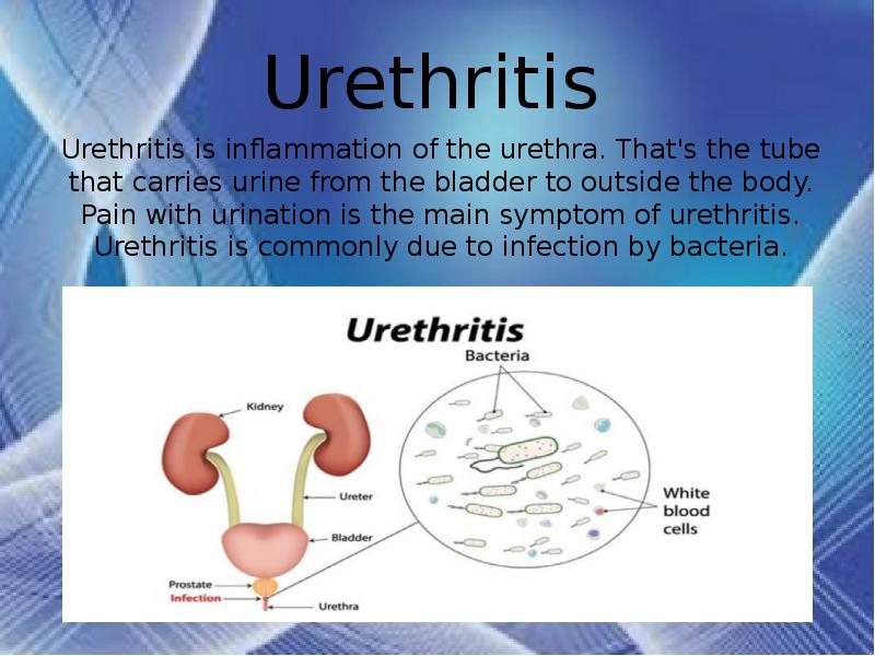 urethritis