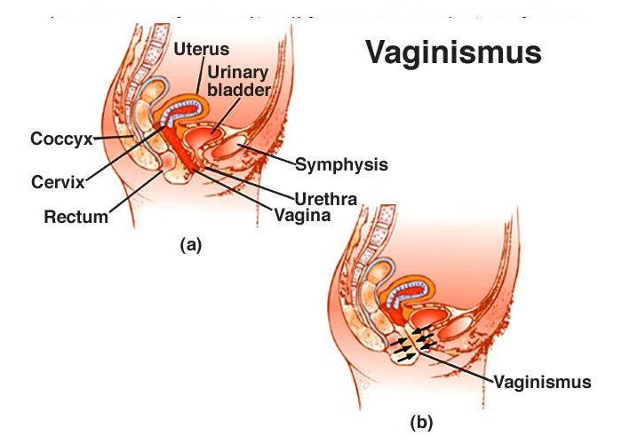 vaginismus